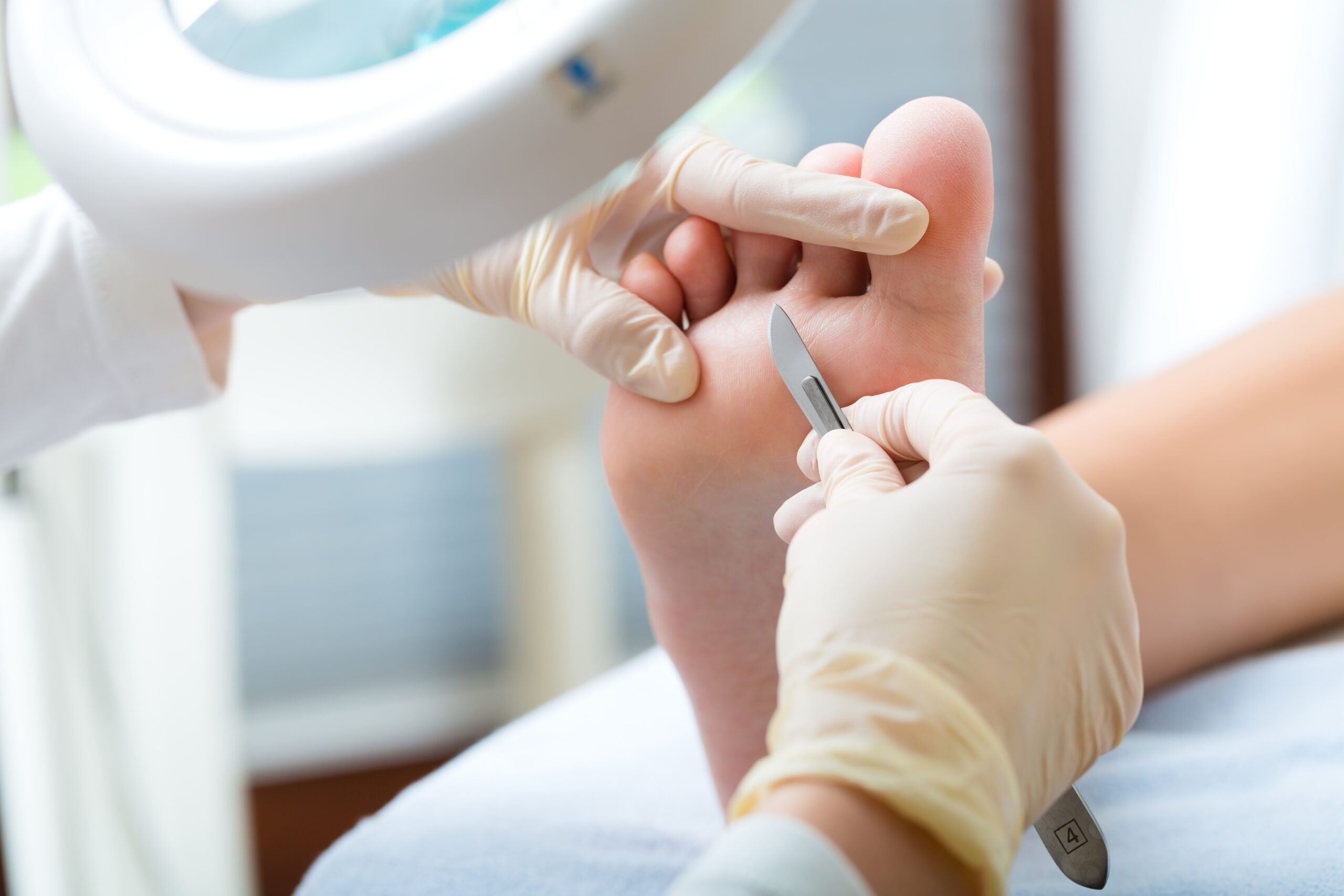 Corns & Callus Removal Prodecure